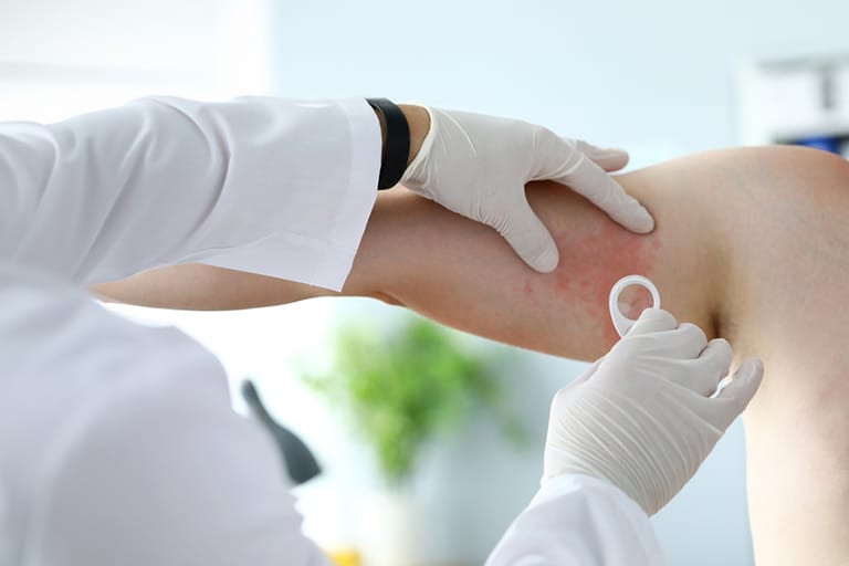 Urticaria clinical trial assessment for a global Phase III study supported by Clinion EDC, RTSM, and ePRO